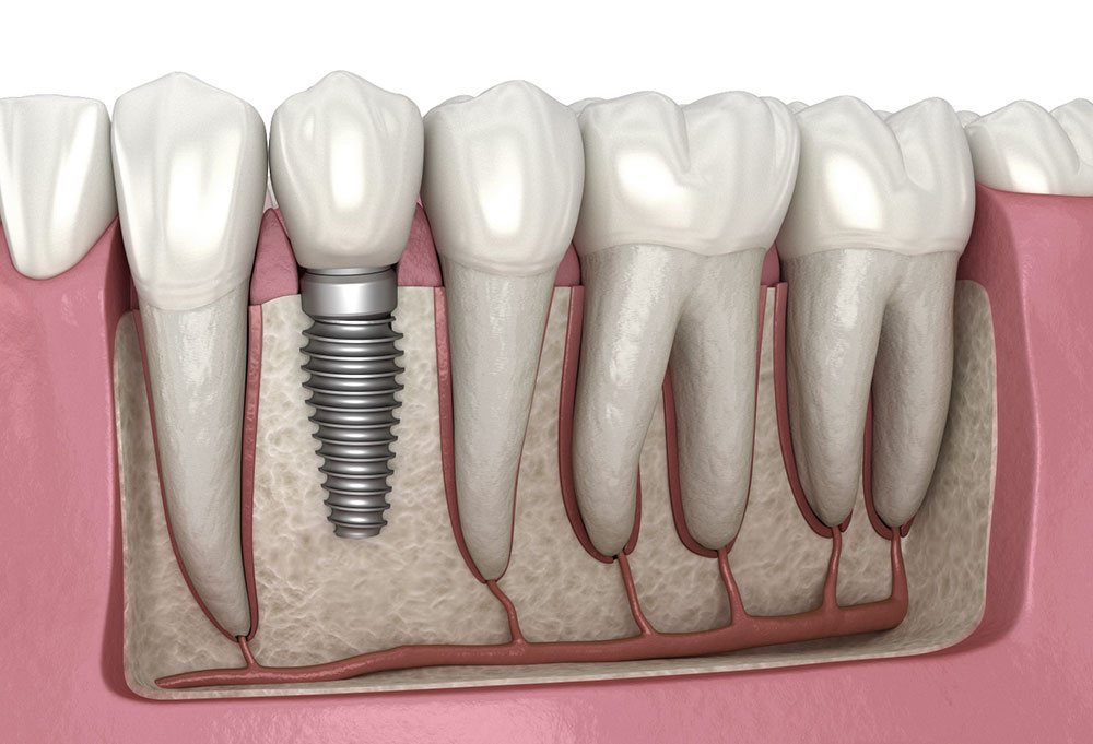 Dental implant treatment in vellore