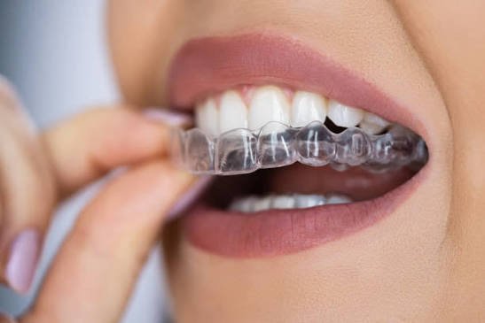 invisalign treatment dental clinic in vellore