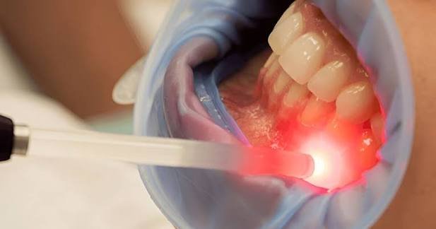 laser dentistry dental clinic in vellore